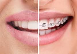 Aligners &amp; Braces